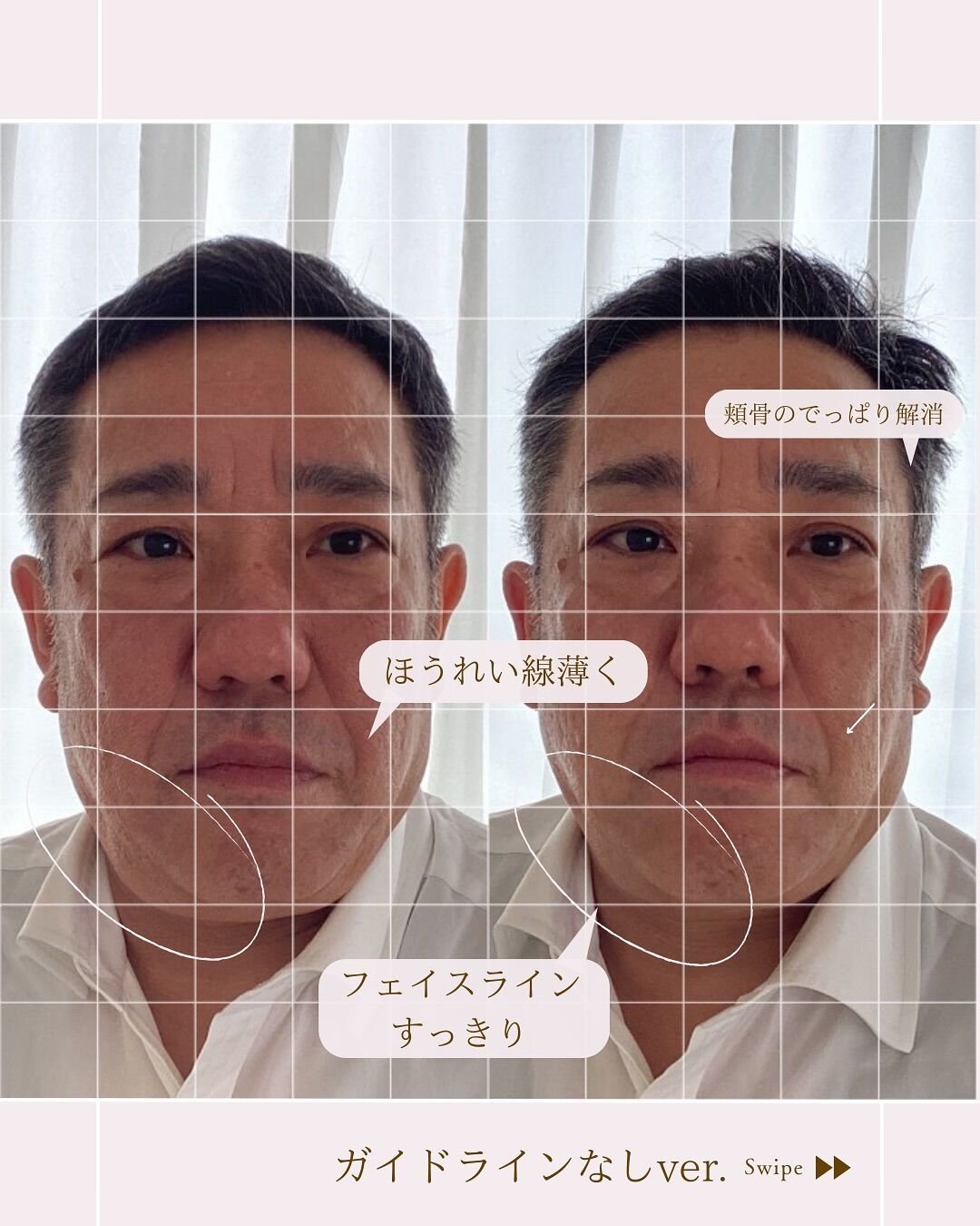 【フェイスライン、1回で変わります！】