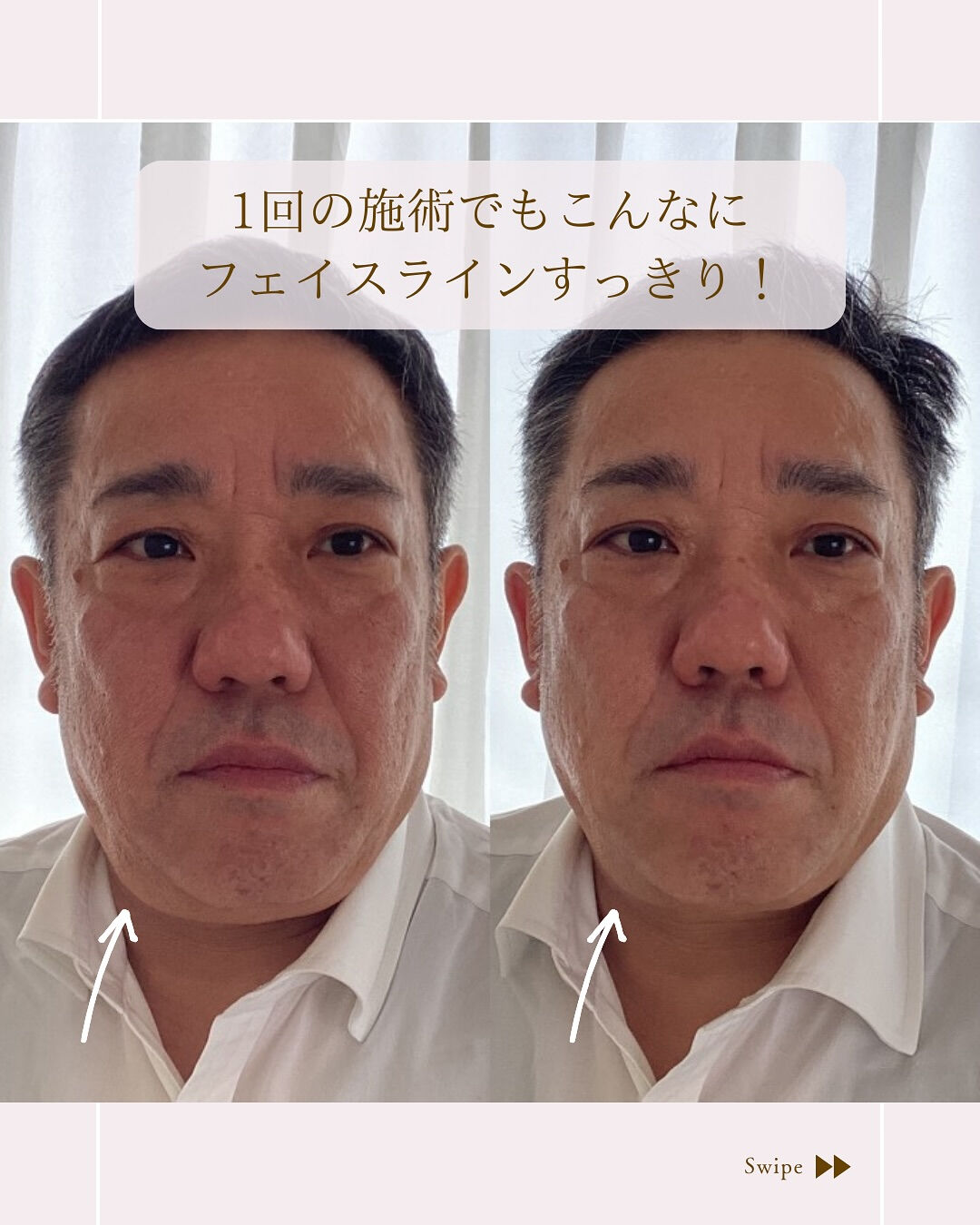 【フェイスライン、1回で変わります！】