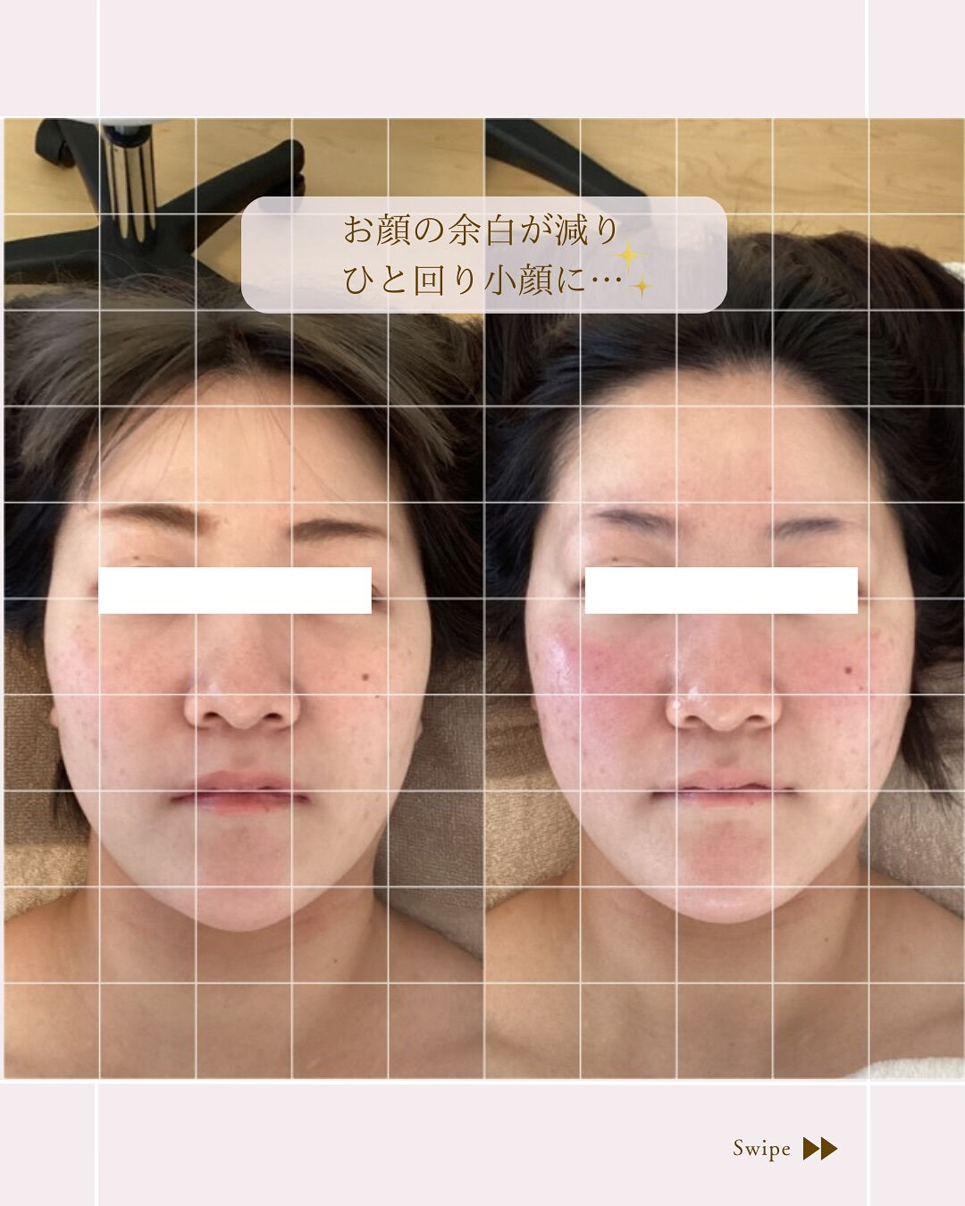⌇1回で顔の余白をなくす⸝⋆