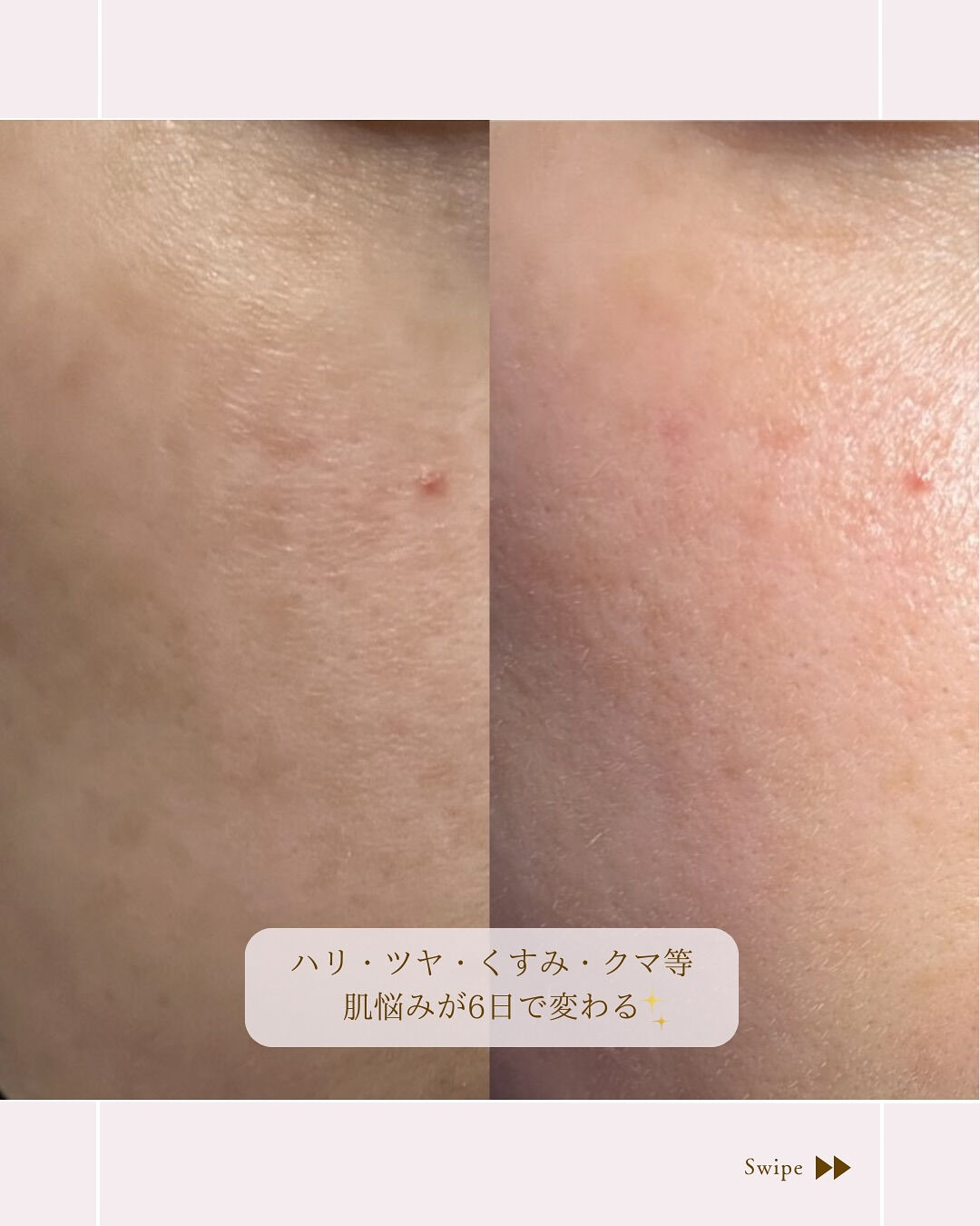 ⌇炭酸ジェルマスク6日間チャレンジ⸝⋆