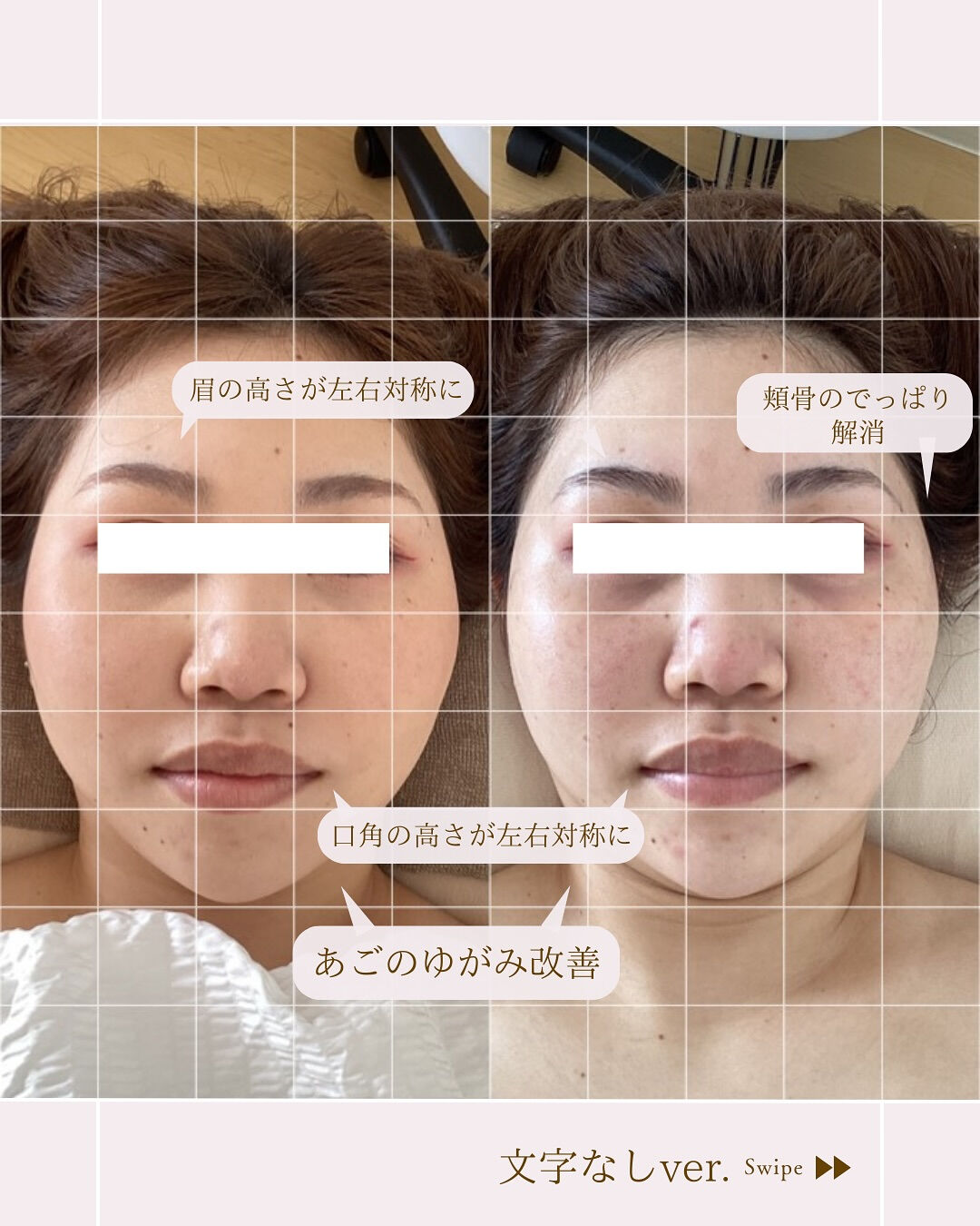 ⌇頬骨のでっぱりも諦めない！