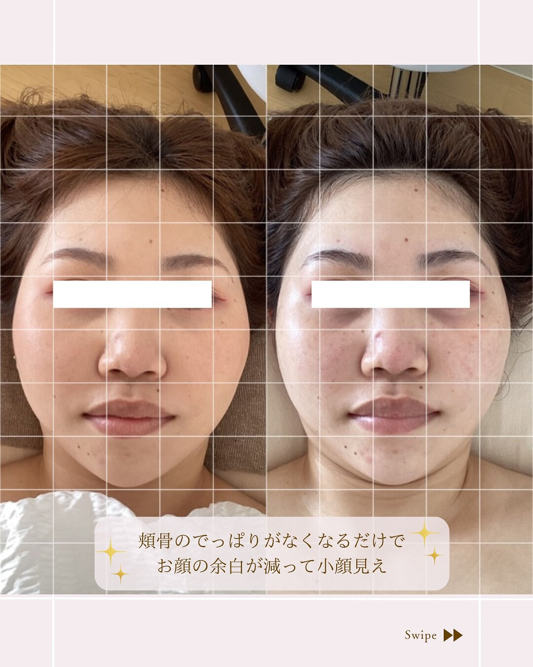 ⌇頬骨のでっぱりも諦めない！