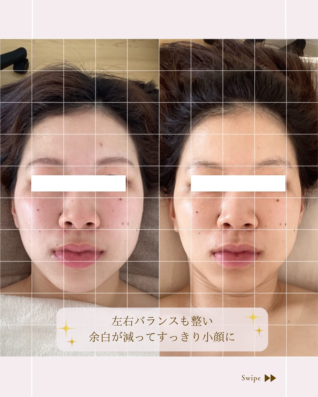 ⌇余白がなくなってお顔すっきり⸝⋆