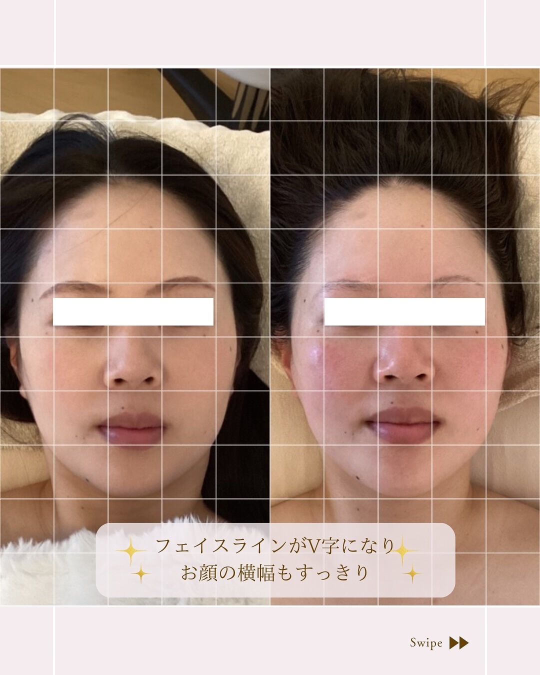⌇2026年は小顔になろう⸝⋆