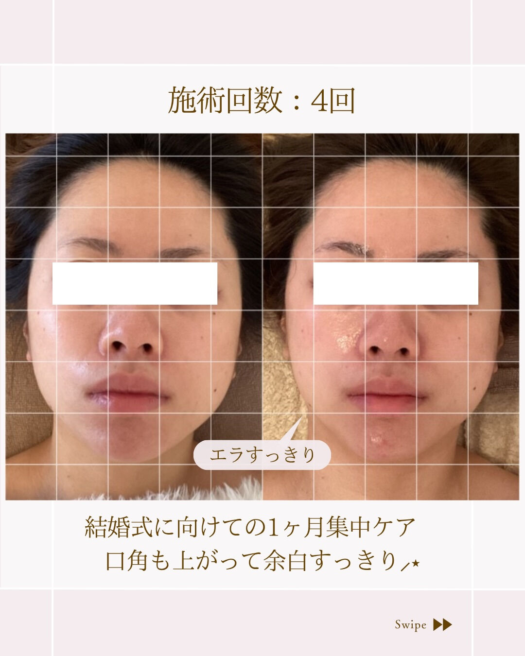 ⌇1ヶ月集中小顔ケア⸝⋆