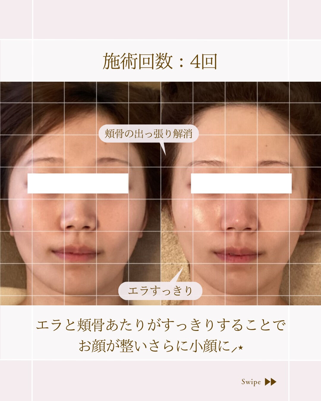 ⌇あなたもまだまだ小顔になれる⸝⋆