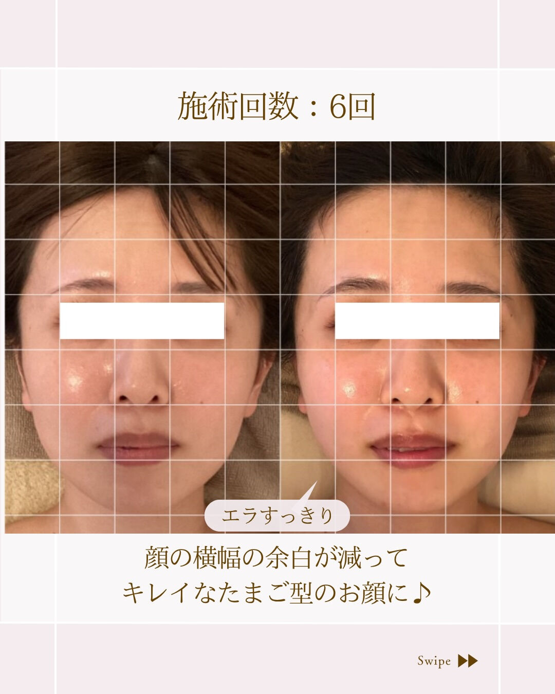 ⌇急いで小顔になりたい方！